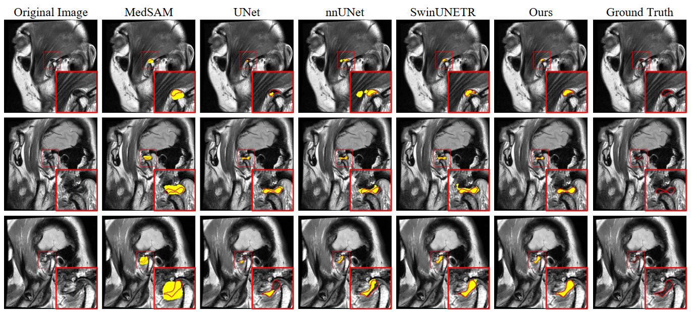 TMJ Disc Segmentation teaser